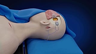 Paralysed patient controls devices with mind after China’s BCI breakthrough in Shanghai